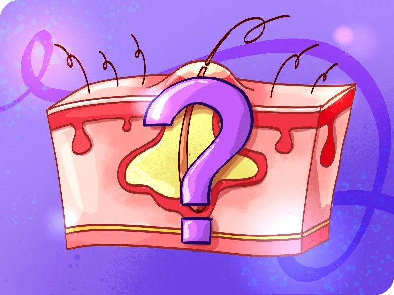 Основные формы акне и&nbsp;как с&nbsp;ними бороться